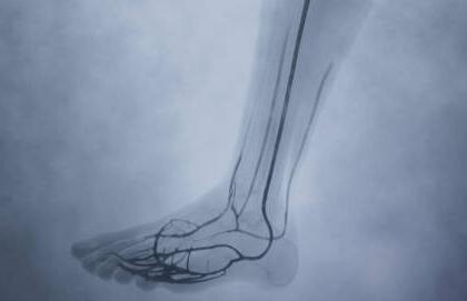 Angiogram image of leg of patient who had LimFlow procedure
